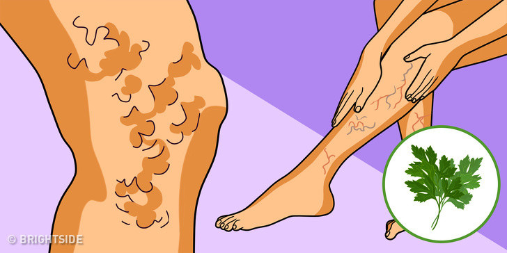 Rau mùi tây cũng điều trị giãn tĩnh mạch rất hiệu quả. Thái một ít mùi tây và cho vào một cốc nước. Đun sôi từ 5-7 phút và để nguội.Thêm một ít tinh dầu vào và bôi lên khu vực bị ảnh hưởng. Thực hiện hai lần một ngày đến khi khỏi.