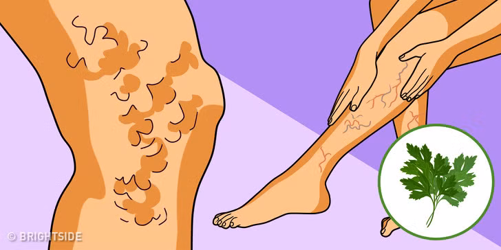 Rau mùi tây cũng điều trị giãn tĩnh mạch rất hiệu quả. Thái một ít mùi tây và cho vào một cốc nước. Đun sôi từ 5-7 phút và để nguội.Thêm một ít tinh dầu vào và bôi lên khu vực bị ảnh hưởng. Thực hiện hai lần một ngày đến khi khỏi.