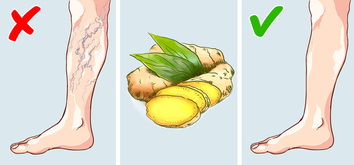 Gừng giúp giảm thiểu nguy cơ xuất hiện giãn tĩnh mạch. Cắt gừng tươi thành từng miếng. Thêm chúng vào một ly nước sôi, để trong 10 phút. Lọc nước và thêm mật ong để uống 2-3 lần/ngày.