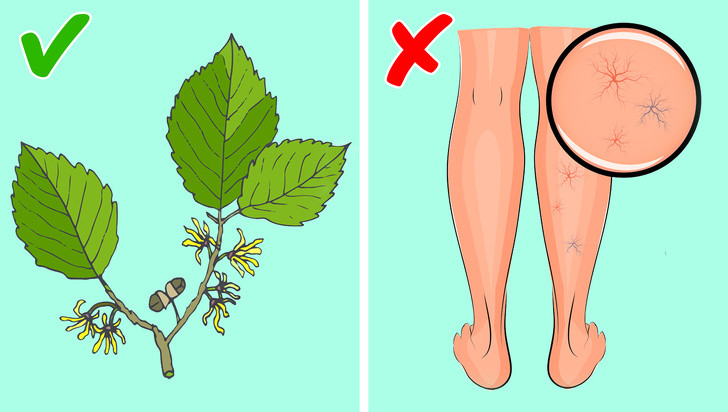 Nước cây phỉ (witch hazel) giúp điều trị các tĩnh mạch bị sưng. Lấy bông ngâm trong nước cây phỉ và đắp lên da trong 10-15 phút. Thực hiện 2-3 lần/ngày.