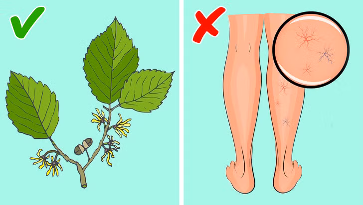 Nước cây phỉ (witch hazel) giúp điều trị các tĩnh mạch bị sưng. Lấy bông ngâm trong nước cây phỉ và đắp lên da trong 10-15 phút. Thực hiện 2-3 lần/ngày.