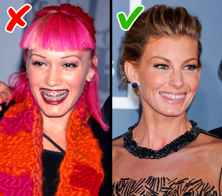 Xu hướng niềng răng màu mè cũng trở nên lạc hậu và bạn không nên làm theo nữa.