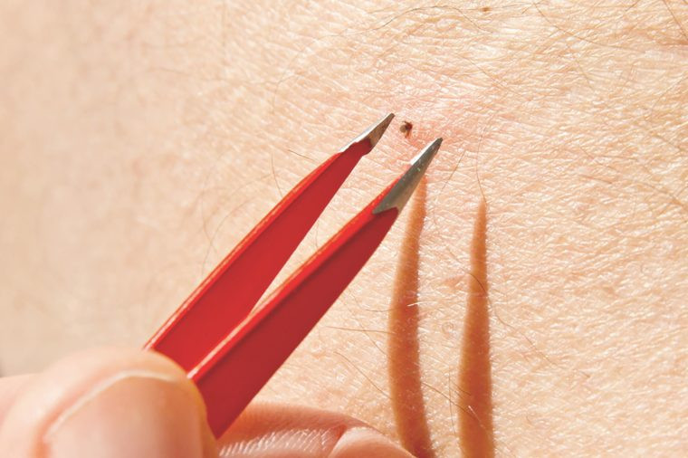 Nếu phát hiện ra ve, nên sử dụng nhíp để gắp lấy đầu con ve, sau đó kéo thẳng ra ngoài. Nhẹ nhàng rửa vết ve cắn bằng xà bông và nước ấm.