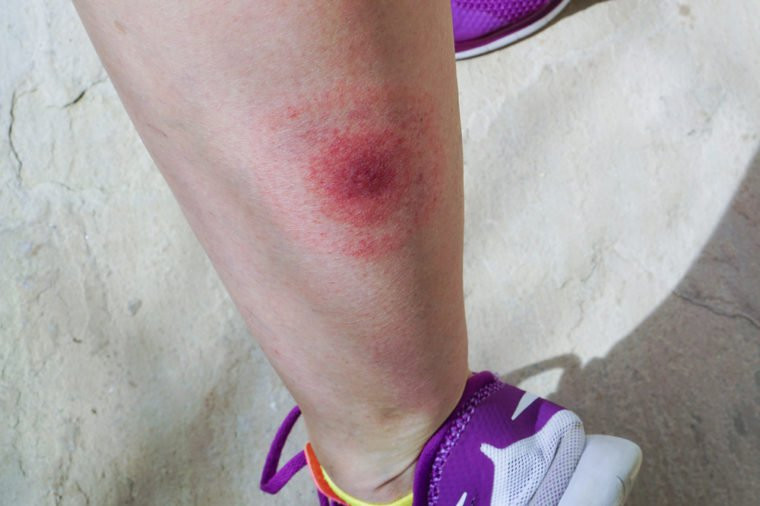 Chú ý theo dõi vết cắn trên da trong khoảng từ 48 đến 72 giờ sau đó.