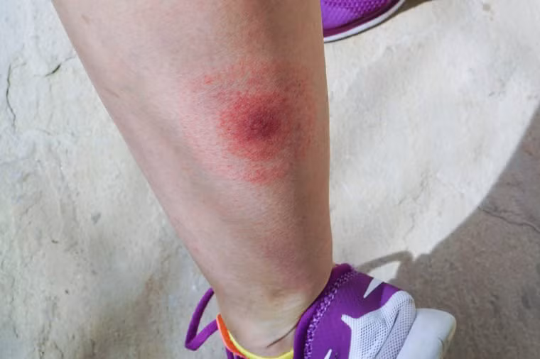 Chú ý theo dõi vết cắn trên da trong khoảng từ 48 đến 72 giờ sau đó.