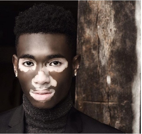 Căn bệnh bạch tạng đã mang đến nét đẹp khác biệt cho anh chàng này.