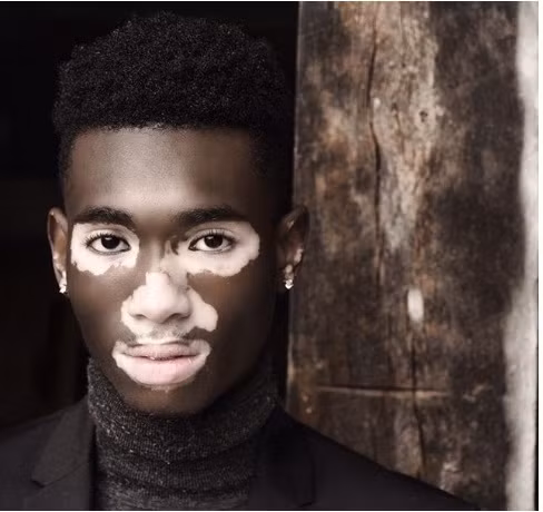 Căn bệnh bạch tạng đã mang đến nét đẹp khác biệt cho anh chàng này.