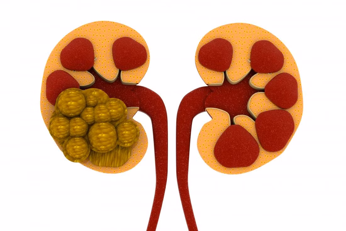 Sỏi thận: Vitamin C có đặc tính làm tăng bài tiết axit uric và oxalat niệu, cả hai đều góp phần tạo thành sỏi thận. Vì vậy, những người có vấn đề về sỏi thận dạng oxalate nên thận trọng.