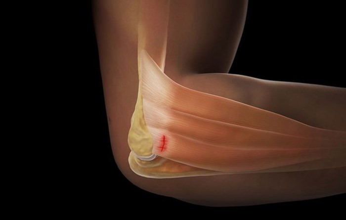 Chấn thương khuỷu tay: Nếu bạn chơi tennis, chơi golf hoặc tham gia vào bất kỳ hoạt động nào đòi hỏi phải sử cổ tay hoặc khuỷu tay thì bạn có nguy cơ bị viêm bán dẫn. Tình trạng này xuất phát từ sự mòn hoặc suy yếu của gân quấn quanh khuỷu tay của bạn và gây ra tình trạng tê tay.