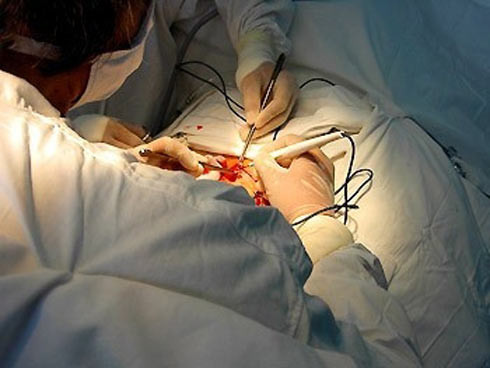 Nếu ung thư lan từ “của quý”, nó thường di chuyển đến các hạch bạch huyết ở bẹn. Việc này có thể khiến những hạch bạch huyết sưng lên. Ung thư cậu nhỏ sớm phát hiện ở giai đoạn đầu sẽ dễ dàng hơn trong điều trị.