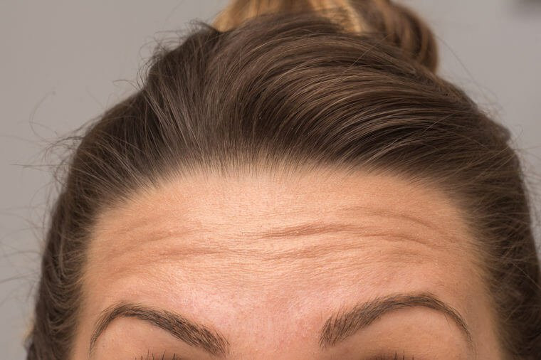 Khi bạn có tuổi, trán cũng có thể là một trong những nơi đầu tiên trên khuôn mặt của bạn xuất hiện các nếp nhăn.