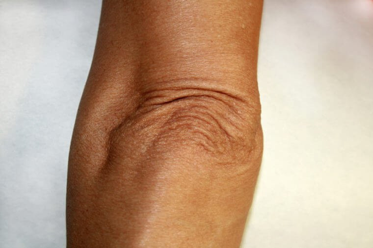 Giống như đầu gối, khuỷu tay của bạn chủ yếu là xương nên sẽ sớm xuất hiện các nếp nhăn khi tuổi tác già đi.