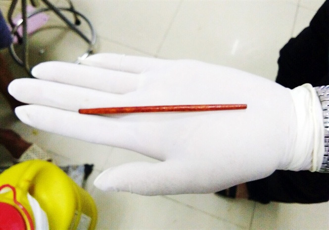 Chiếc đũa dài 12cm được lấy ra khỏi “cậu nhỏ” của bệnh nhân. Ảnh: BVHM ĐN.