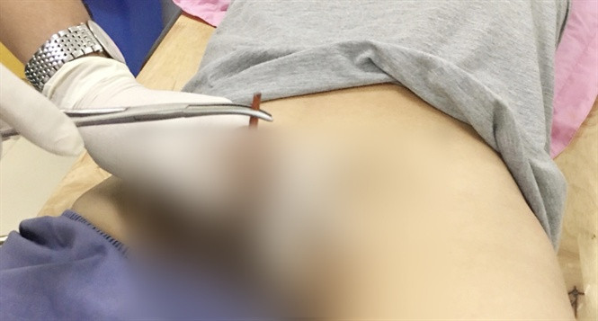 Chiếc đũa cắm vào niệu đạo “cậu nhỏ”. Ảnh: BVHM ĐN.