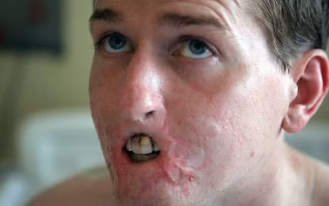 Một phần gương mặt của Lewis nhiễm độc tới mức phải cắt bỏ phần môi. Một phần gương mặt của Lewis nhiễm độc tới mức phải cắt bỏ phần môi.