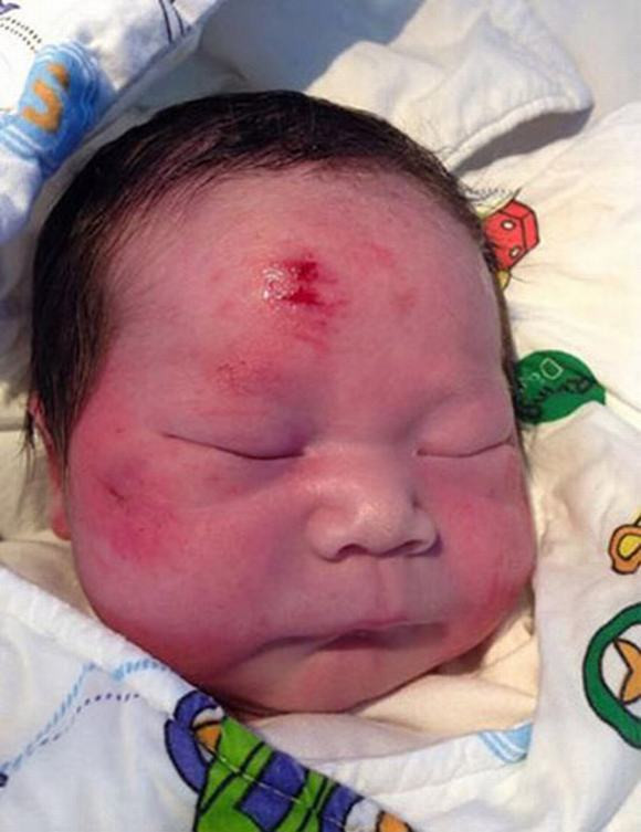 Cú va chạm mạnh khiến thai nhi trong bụng người phụ nữ xấu số "bắn" ra ngoài và nằm cách cha mẹ vài mét. Bé sơ sinh nặng 3,8kg được chuyển tới bệnh viện chăm sóc và sức khỏe của bé đã ổn định trở lại. Ảnh: Internet.