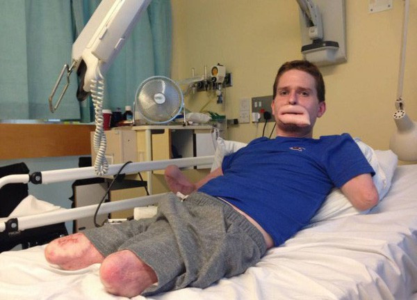 Trải qua ca phẫu thuật ghép môi, Alex Lewis đã có cặp môi mà anh hài hước so sánh với các nhân vật trong bộ phim Gia đình Simpson.