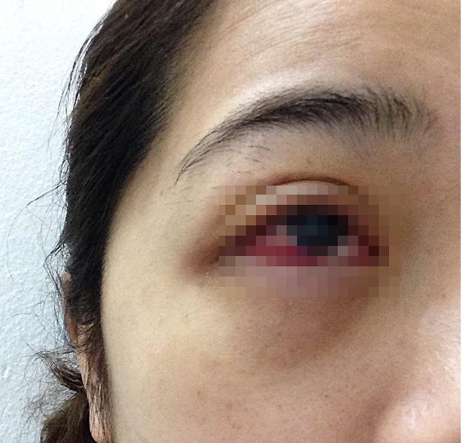 Mắt Hà Trinh sưng đỏ, nhiễm trùng sau khi nối mi. Ảnh: NVCC.