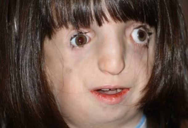 Treacher Collins Syndrome là một tình trạng rất hiếm gây ra các dị dạng trên khuôn mặt. Nguồn ảnh: List25.