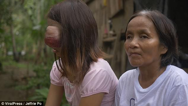 Ung thư võng mạc là một loại ung thư mắt hiếm gặp thường ảnh hưởng đến trẻ em dưới năm tuổi. Có khoảng 98% trẻ em mắc bệnh được điều trị thành công.