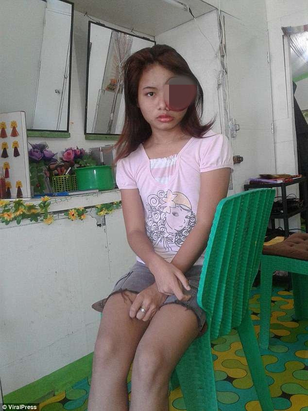 Khối u ngày càng to lên khiến cô bé dần bị mất thị lực.