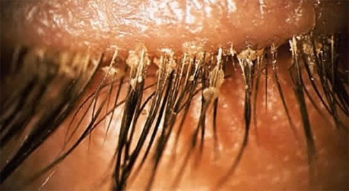 Rận mu là ký sinh trùng sống ở lỗ chân lông vùng sinh dục, gây ngứa ngáy rất khó chịu và lây qua đường tình dục.