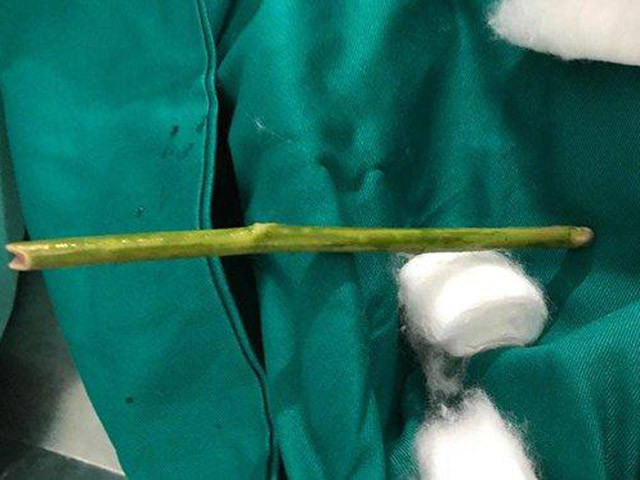 Dùng que chọc vào âm đạo: Trước đó không lâu, khoảng tháng 12/2017, một phụ nữ ngoài 20 tuổi ở Tuyên Quang suýt mất mạng vì tự phá thai tại nhà. Bệnh nhân vào Bệnh viện Đa khoa tỉnh Tuyên Quang trong tình trạng chảy máu âm đạo, đau bụng nhiều, cổ tử cung hé mở do tự phá thai.