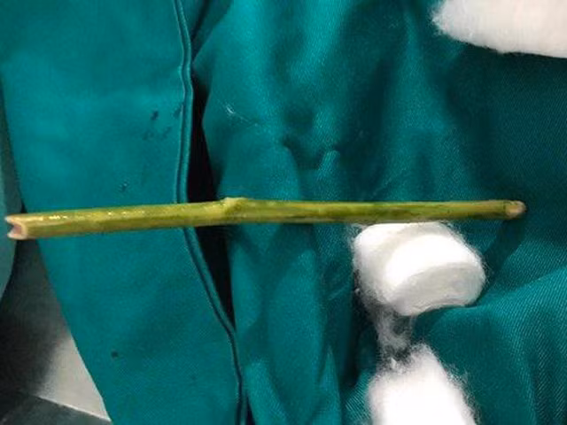 Dùng que chọc vào âm đạo: Trước đó không lâu, khoảng tháng 12/2017, một phụ nữ ngoài 20 tuổi ở Tuyên Quang suýt mất mạng vì tự phá thai tại nhà. Bệnh nhân vào Bệnh viện Đa khoa tỉnh Tuyên Quang trong tình trạng chảy máu âm đạo, đau bụng nhiều, cổ tử cung hé mở do tự phá thai.