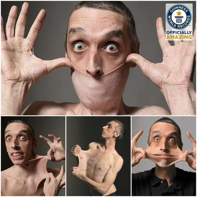 Ông Garry Turner ở Caistor (Anh) sở hữu bộ phận cơ thể “độc” nhất khi lớp da đặc biệt có thể kéo giãn đến 15,8 cm. Sở dĩ như thế là do ông mắc tình trạng bệnh lý hiếm gặp gọi là hội chứng Ehlers-Danlos, một rối loạn di truyền gây tăng khả năng đàn hồi của da.