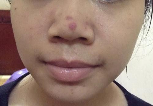 Mụn bọc xấu xí khiến chị em đau đầu tìm cách tiêu diệt.