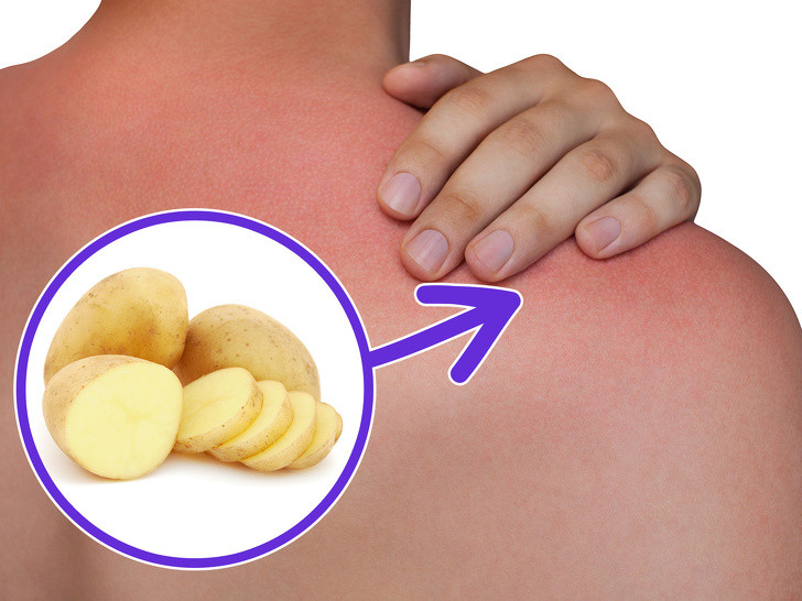 Khi bị bỏng, bạn hãy cắt một khoanh khoai tây đắp lên chỗ bỏng, để yên một lúc lâu. Điều nên nhớ là trước khi đắp, không được rửa vết bỏng.