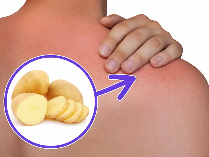 Khi bị bỏng, bạn hãy cắt một khoanh khoai tây đắp lên chỗ bỏng, để yên một lúc lâu. Điều nên nhớ là trước khi đắp, không được rửa vết bỏng.