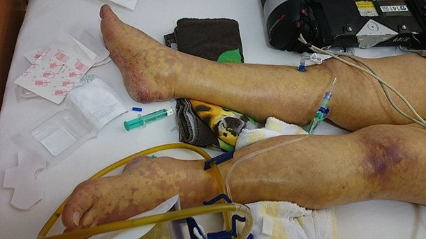 Robert Butler từng nặng 544kg và ông phải giảm vài trăm kg để có thể đi lại bình thường. Nhưng không may ở tuổi 43, ông qua đời do các biến chứng từ bệnh nhiễm khuẩn huyết.