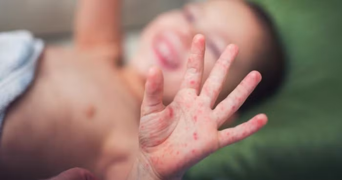 Tre bi tay chan mieng tro nang do chung vi rut nguy hiem tai xuat-Hinh-2