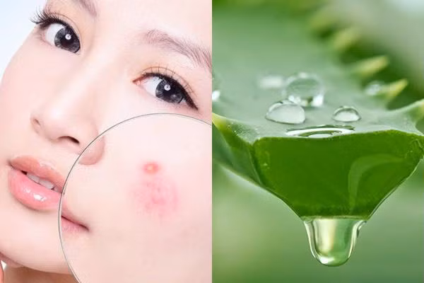 Trị mụn cóc hiệu quả tại nhà với nha đam tươi (Ảnh: Internet).