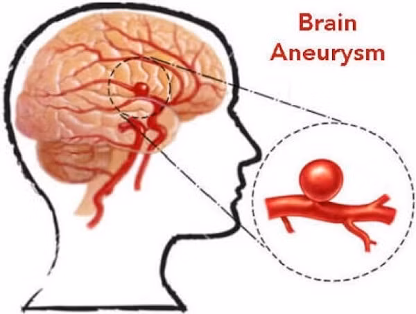 Phình mạch não: Theo Hiệp hội Đột quỵ Mỹ, khoảng 3- 5 triệu người dân nước này có chỗ phình bất thường trên thành mạch máu não. Phần lớn bệnh diễn ra âm thầm, không đưa ra bất kỳ triệu chứng cảnh báo điển hình nào.