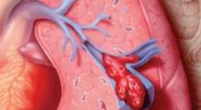 Thuyên tắc phổi: 1/2 người có cục máu đông trong phổi không có bất kỳ triệu chứng nào. Tuy nhiên mỗi năm có tới 100.000 người ở Mỹ bị cục máu làm tắc lưu thông máu, tăng huyết áp trong phổi và tim khó hoạt động bình thường.