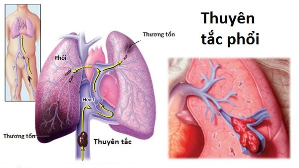 Dấu hiệu cảnh báo bao gồm đau và sưng ở cánh tay hoặc chân không mất đi trong vòng 1-2 ngày, đặc biệt nếu bạn vừa mới bị gãy xương, có một chuyến bay dài hoặc thời gian không vận động quá lâu.