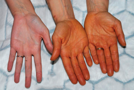 Hiện tượng lycopenodermia: Cà chua rất giàu lycopen, hợp chất có lợi cho sức khỏe. Tuy nhiên, ăn quá nhiều lycopen lại có thể dẫn đến một hiện tượng gọi là lycopenodermia, khiến da bạn chuyển sang màu da cam đậm nhưng không gây hại co sức khỏe.