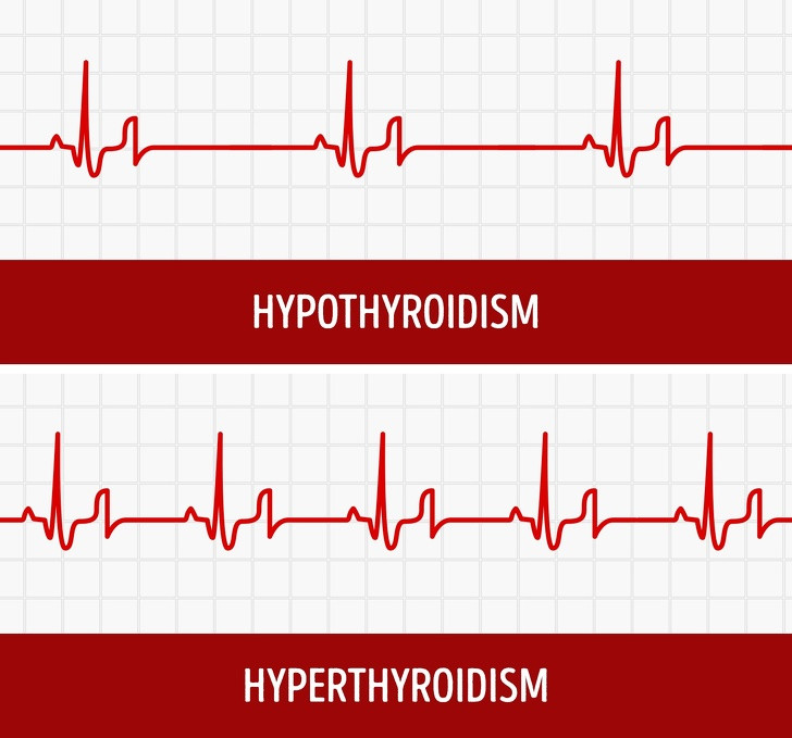 Nhịp tim thay đổi: Dưới sự bài tiết của hormon tuyến giáp có thể khiến tim đập chậm, trong khi cường giáp gây ra nhịp tim nhanh. Ảnh: BS.