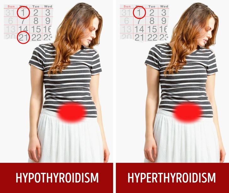Kinh nguyệt bất thường: Nếu bạn đang gặp vấn đề về kinh nguyệt, nguyên nhân có thể là do chức năng tuyến giáp đang có vấn đề. Việc thiếu hormone sẽ làm cho kỳ kinh nguyệt ra nhiều máu hơn, dài hơn hoặc ngắn hơn.