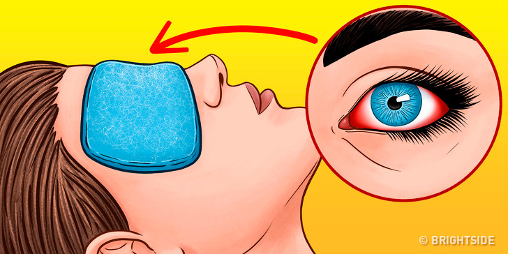 Chườm ấm hoặc lạnh để giảm đỏ: Nếu đôi mắt đang bị sưng đỏ, bạn có thể lấy một miếng gạc ấm chườm mắt trong 10 phút. Hãy chắc chắn rằng nhiệt độ dễ chịu cho mắt. Ảnh: BS.