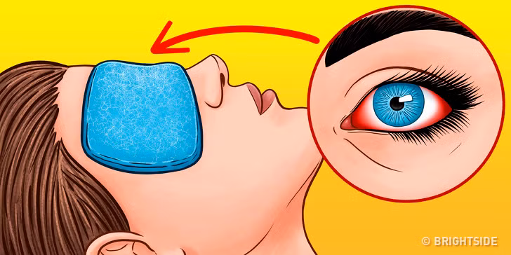 Chườm ấm hoặc lạnh để giảm đỏ: Nếu đôi mắt đang bị sưng đỏ, bạn có thể lấy một miếng gạc ấm chườm mắt trong 10 phút. Hãy chắc chắn rằng nhiệt độ dễ chịu cho mắt. Ảnh: BS.