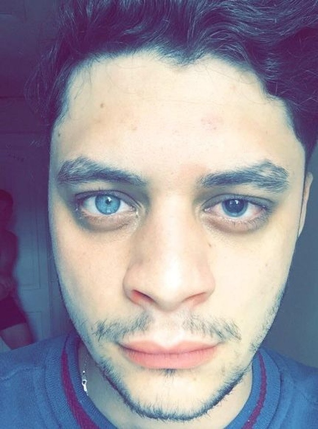 Người đàn ông này mắc phải chứng đồng tử không đều (Anisocoria), có nghĩa là kích thước con ngươi không đồng đều.