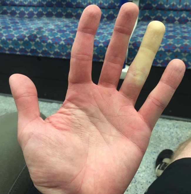 Ngón tay áp út của người này hóa trắng mỗi khi bị lạnh.