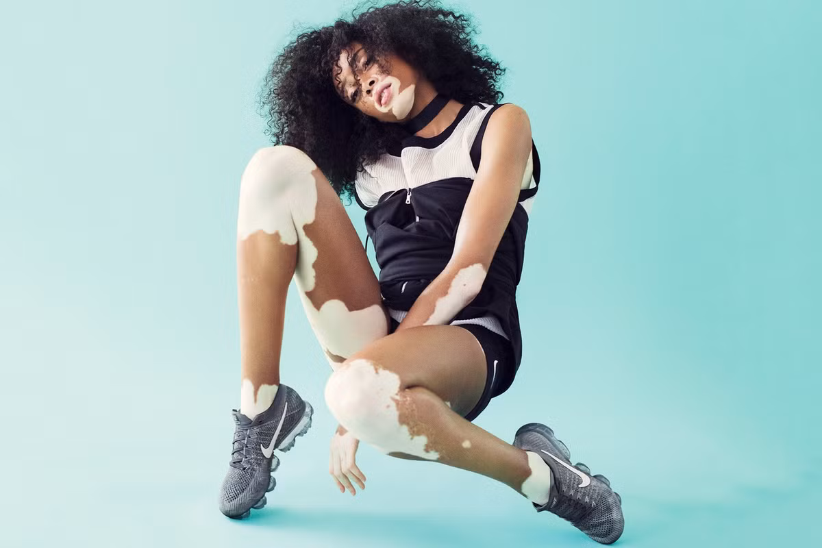 Winnie Harlow là người mẫu nổi tiếng ở Canada, năm 1994, có vẻ ngoài vô cùng khác biệt. Winnie mắc chứng bạch biến khiến cơ thể loang lổ những đốm trắng. Ảnh: BS.