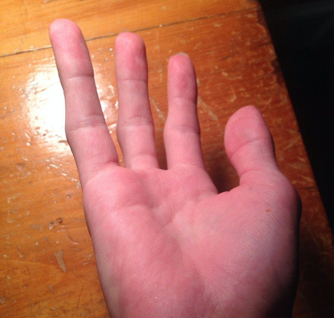 Người đàn ông này sinh ra đã thiếu mất ngón tay út.