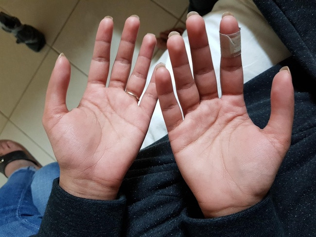 Cả hai bàn tay của cô gái này thiếu khớp và nếp gấp ở ngón cái.