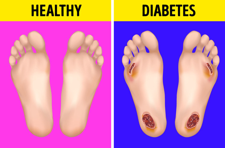 Chân lở loét lâu: Nếu vết loét bàn chân lâu khỏi, thậm chí kéo dài mãi giống như vết thương hở thì rất có thể đó là một dấu hiệu của bệnh tiểu đường. Khi thấy dấu hiệu này trên chân, bạn cần đi khám ngay.