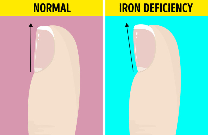Móng chân bị trũng hoặc lõm xuống (Koilonychia): Koilonychia là tình trạng móng tay, móng chân mỏng bất thường, có thể phẳng hoặc cong lõm xuống trông như cái thìa. Tình trạng này có liên quan đến tình trạng thiếu sắt, hay còn gọi là thiếu máu.